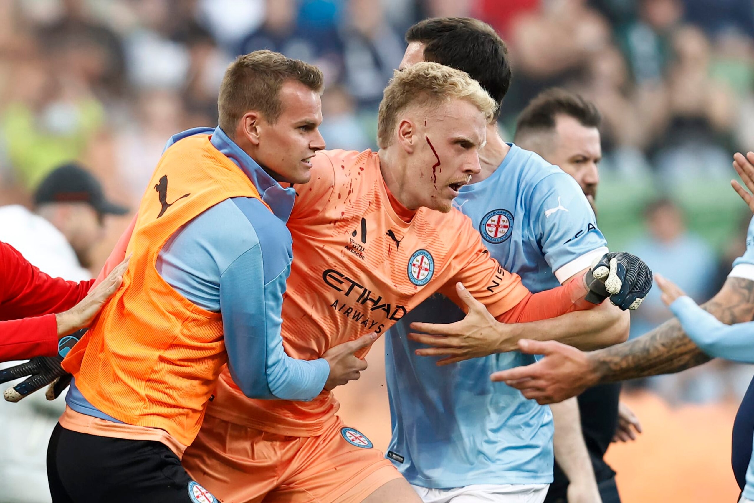 MELBOURNE, AUSTRALIA - DECEMBER 17: A bleeding Tom Glover of Melbourne City is escorted from the pitch by team mates after fans stormed the pitch during the round eight A-League Men's match between Melbourne City and Melbourne Victory at AAMI Park, on December 17, 2022, in Melbourne, Australia. (Photo by Darrian Traynor/Getty Images) MELBOURNE, AUSTRALIA - DECEMBER 17: A bleeding Tom Glover of Melbourne City is escorted from the pitch by team mates after fans stormed the pitch during the round eight A-League Men's match between Melbourne City and Melbourne Victory at AAMI Park, on December 17, 2022, in Melbourne, Australia. (Photo by Darrian Traynor/Getty Images)