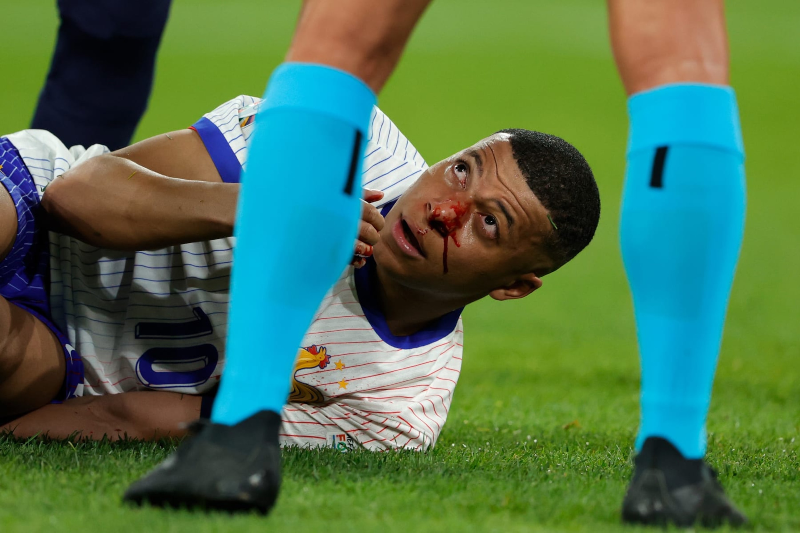 DUSSELDORF, GERMANY - JUNE 17: Kylian Mbappe of France Injured his head during the EURO match between Austria v France at the Merkur Spiel Arena on June 17, 2024 in Dusseldorf Germany (Photo by Rico Brouwer/Soccrates/Getty Images) DUSSELDORF, GERMANY - JUNE 17: Kylian Mbappe of France Injured his head during the EURO match between Austria v France at the Merkur Spiel Arena on June 17, 2024 in Dusseldorf Germany (Photo by Rico Brouwer/Soccrates/Getty Images)