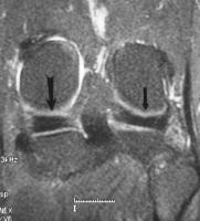 Medial and lateral meniscus (smaller arrow)