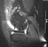anterior, middle and posterior segments of the meniscus