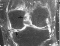 Medial meniscus tear