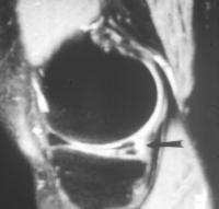 Tear of the posterior meniscus body and posterior horn