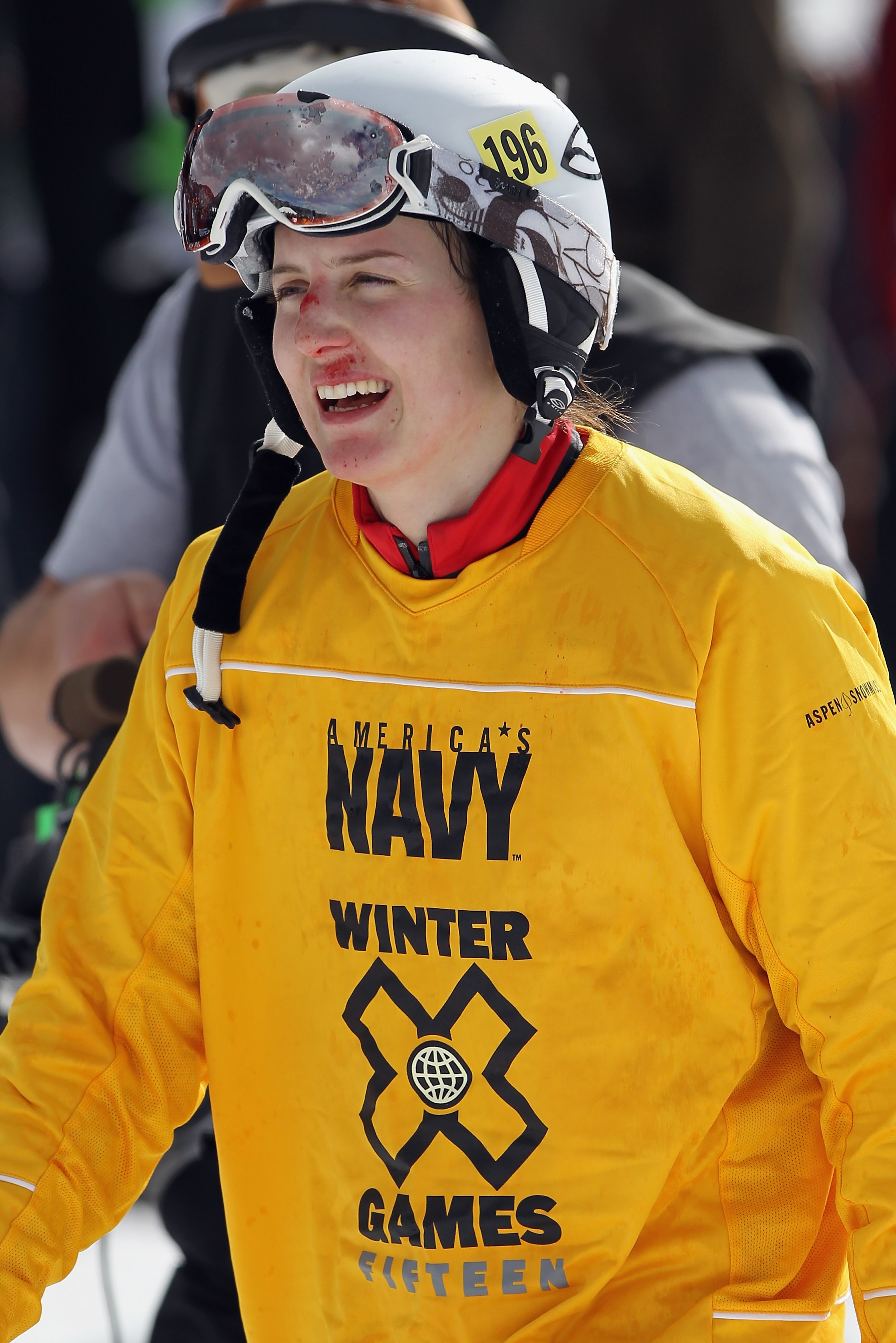 ASPEN, CO - JANUARY 30:  Kelsey Serwa of Canada exhibits her wounds after crashing at the finish line to win the gold medal in the finals of the Women's Skier X at Winter X Games 15 at Buttermilk Mountain on January 30, 2011 in Aspen, Colorado.  (Photo by