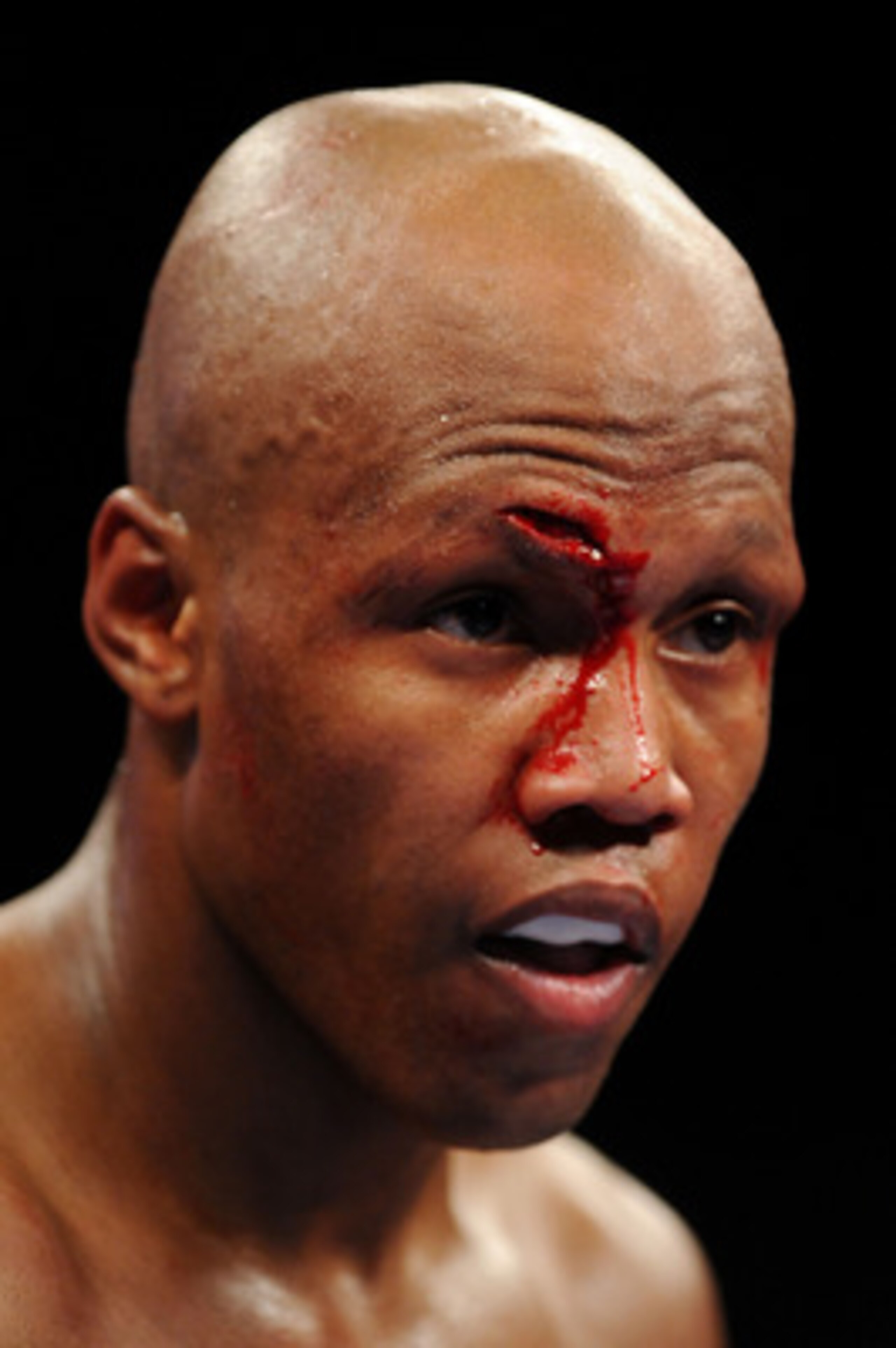 NEW YORK - NOVEMBER 08:  Zab Judah looks on with blood dripping down his face from a wound received from opponent Ernest Johnson during their Welterweight bout at Madison Square Garden November 8, 2008 in New York City.  (Photo by Al Bello/Getty Images)