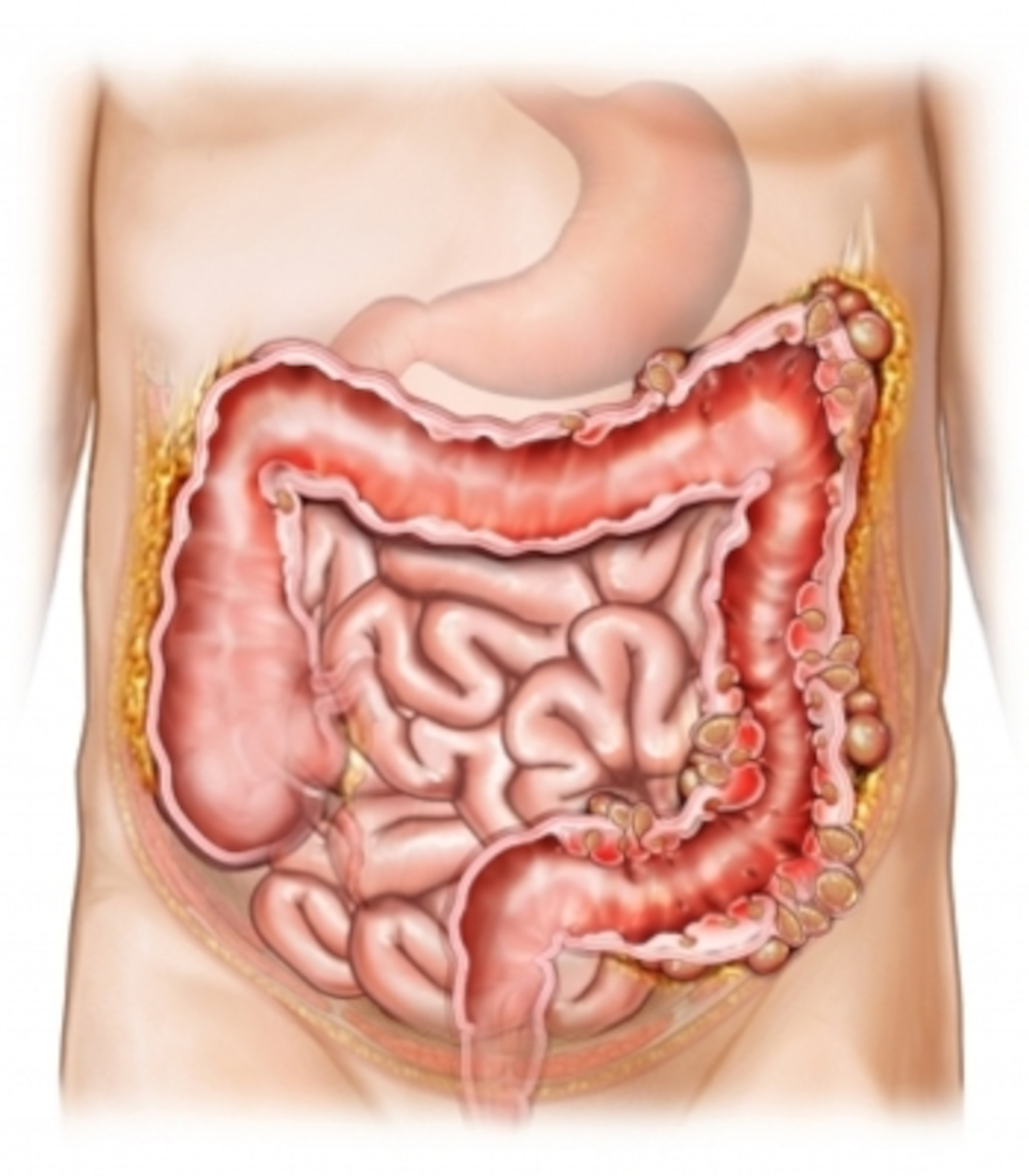 An animated depiction of diverticulitis.