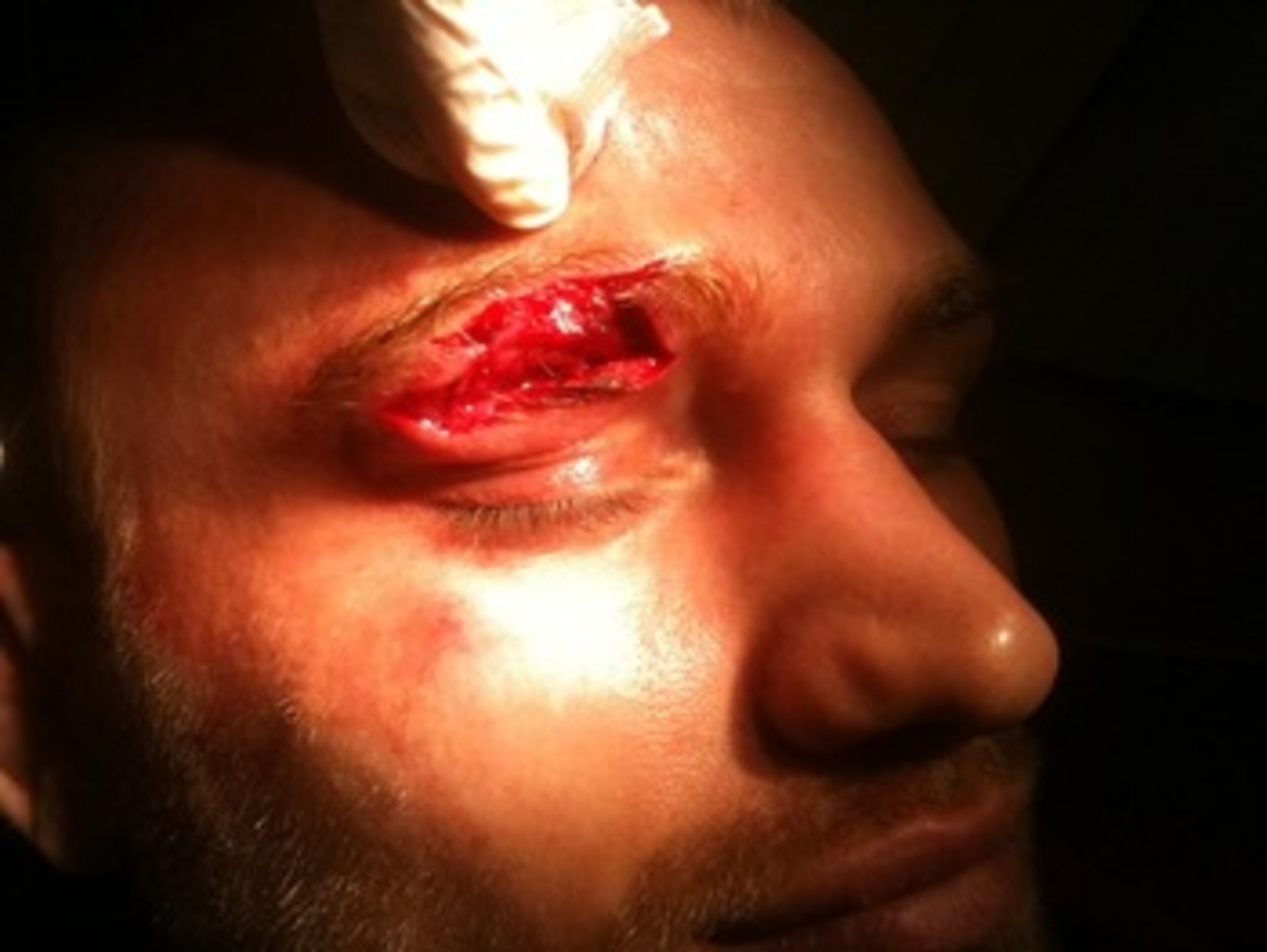 Martin Kampmann training injury
