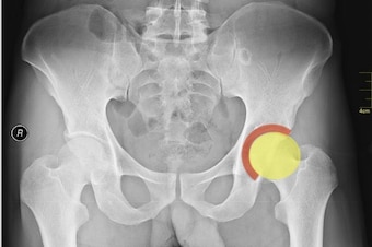 The head of the femur (represented by a yellow circle) lies within the acetabular labrum, seen here as a red arc.