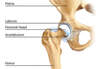 Hip dislocations—when the femur slips out of the acetabulum—can damage the labrum.
