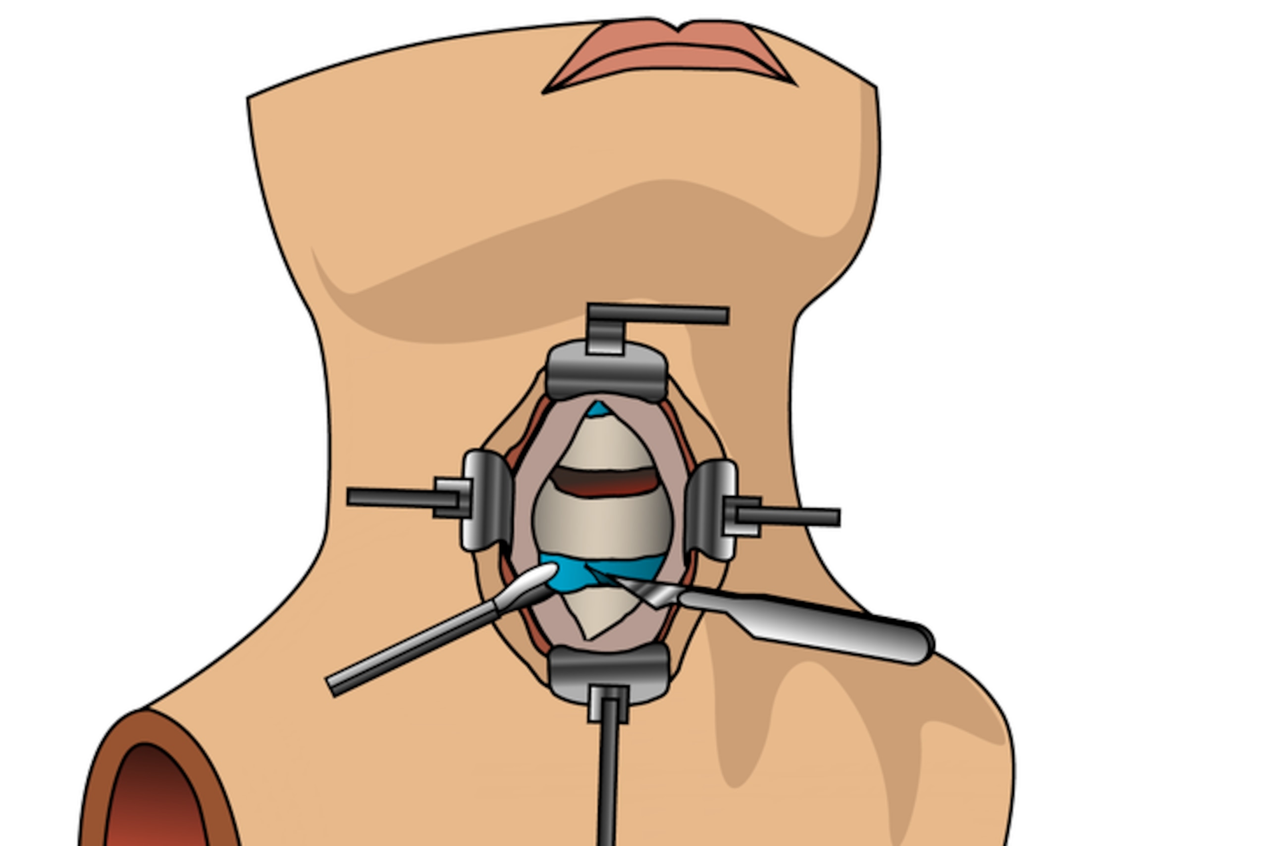 In an ACDF, surgeons approach the spine from the front of the neck—the "anterior" side.
