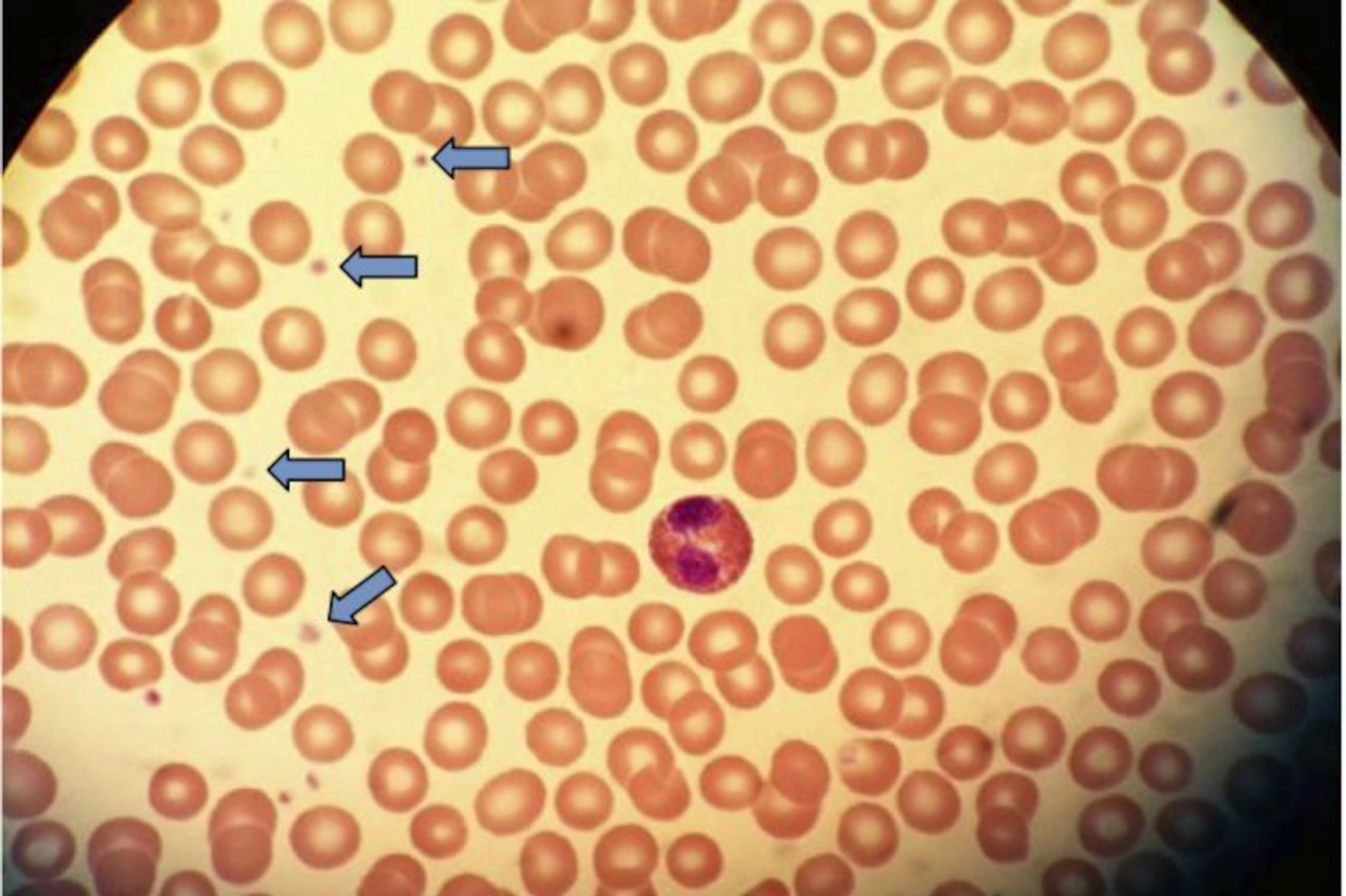Platelets, highlighted here by blue arrows and sitting amongst many red blood cells, carry many different types of healing proteins.
