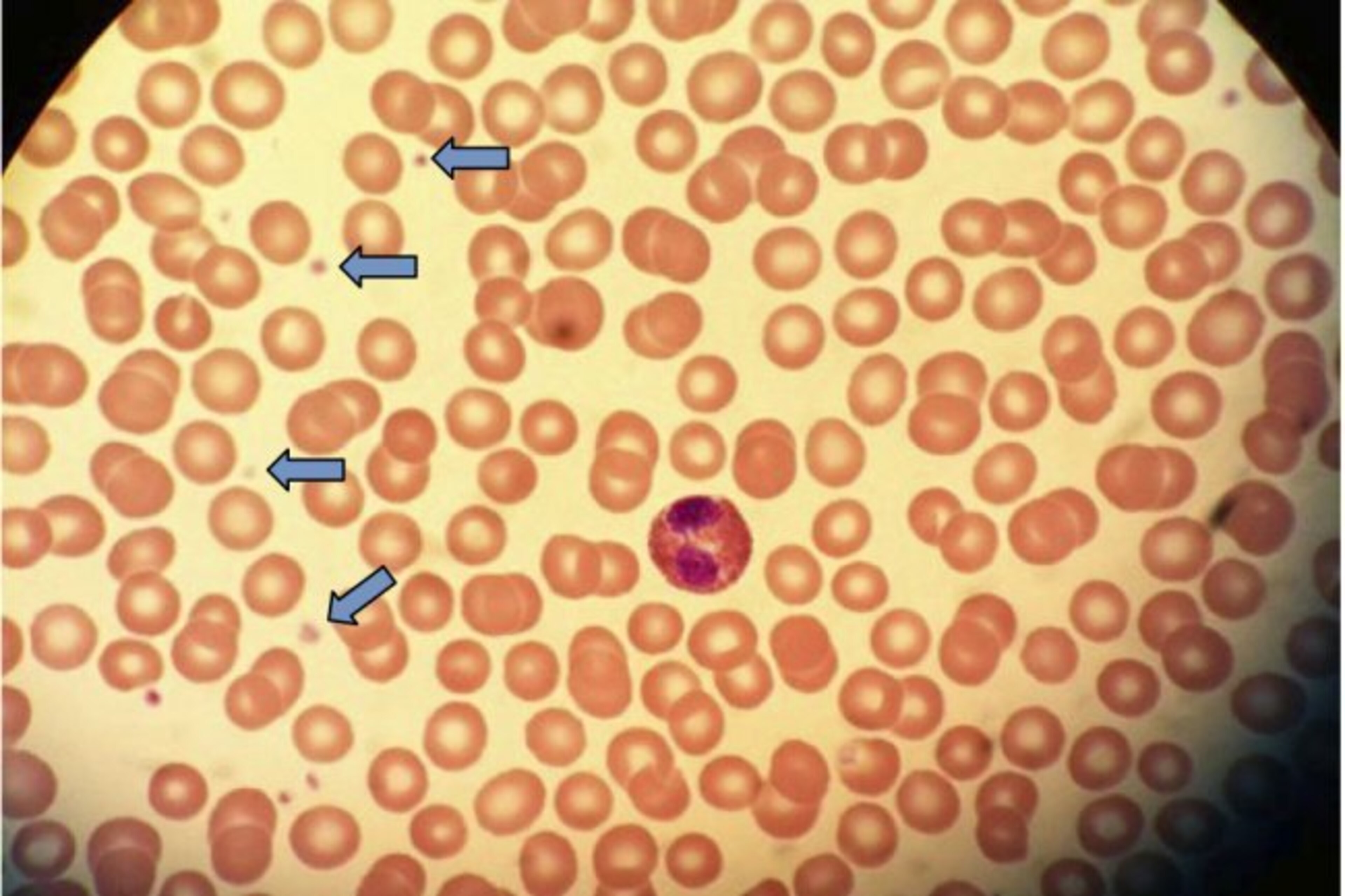 Platelets, highlighted here by blue arrows and sitting amongst many red blood cells, carry many different types of healing proteins. Platelets, highlighted here by blue arrows and sitting amongst many red blood cells, carry many different types of healing proteins.