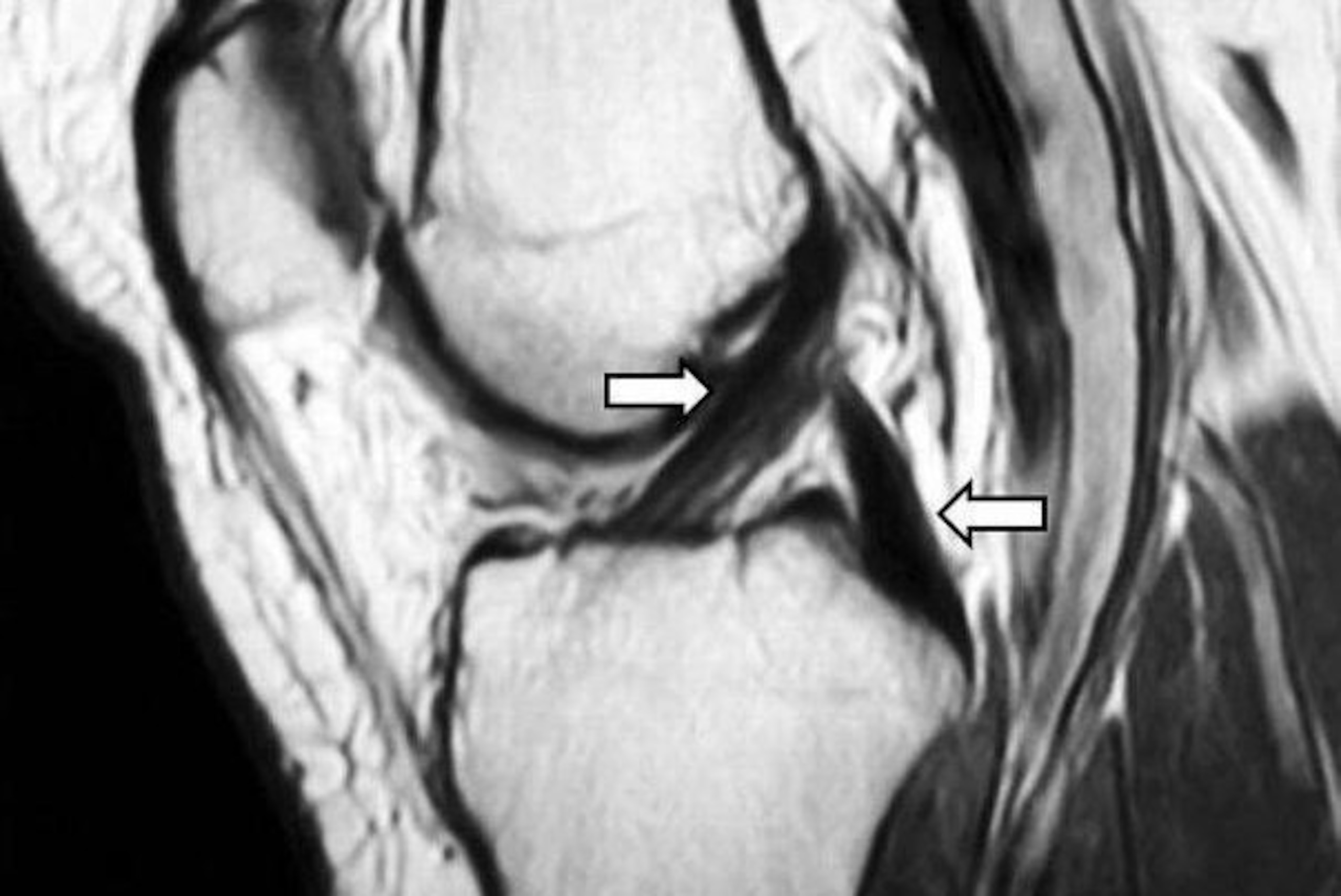 MRIs allow doctors to closely inspect soft tissues such as ligaments and tendons. In this knee MRI, the anterior cruciate ligament (ACL) and posterior cruciate ligament (PCL) are marked by the left and right arrows, respectively.