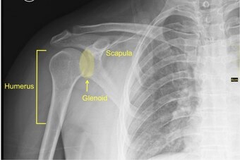 The humerus—or upper arm bone—sits within the glenoid of the scapula, or shoulder socket.