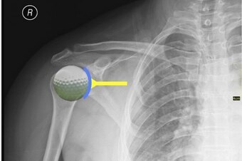 The shoulder mirrors a golf ball sitting on a tee. The golf ball represents the head of the humerus, and the tee represents the glenoid. The labrum is a supportive extension of the "tee," seen in blue above.
