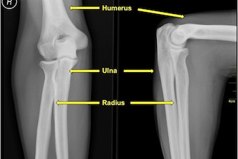 The radius, ulna and humerus meet at the elbow.