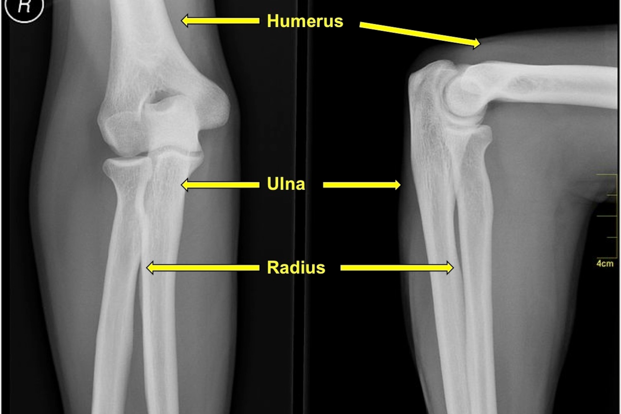 The radius, ulna and humerus meet at the elbow.