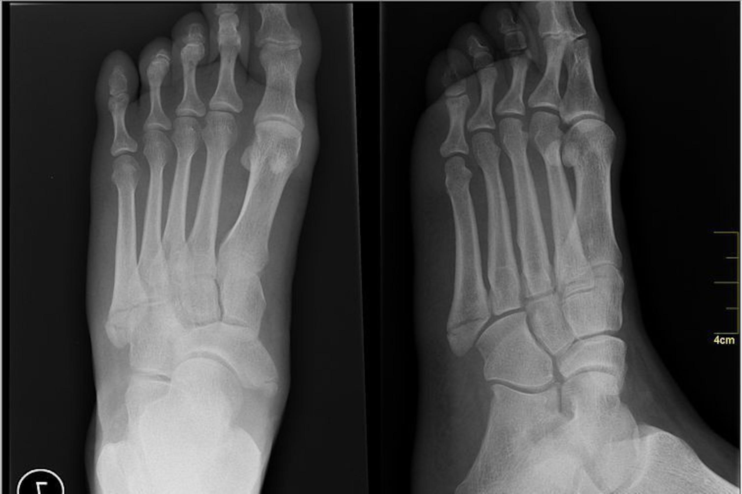 X-rays may not always show a stress fracture.