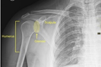 The shoulder marks the point where the humerus—or upper arm bone—meets the scapula, or shoulder blade. It does so by resting within the glenoid—or shoulder socket.