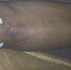 Harrington's right knee two weeks after surgery, with the staph infection.