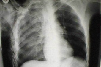 This X-ray shows findings—white haziness on the left side, the patient's right lung—that may represent a pulmonary contusion. On the left side (the patient's right lung).