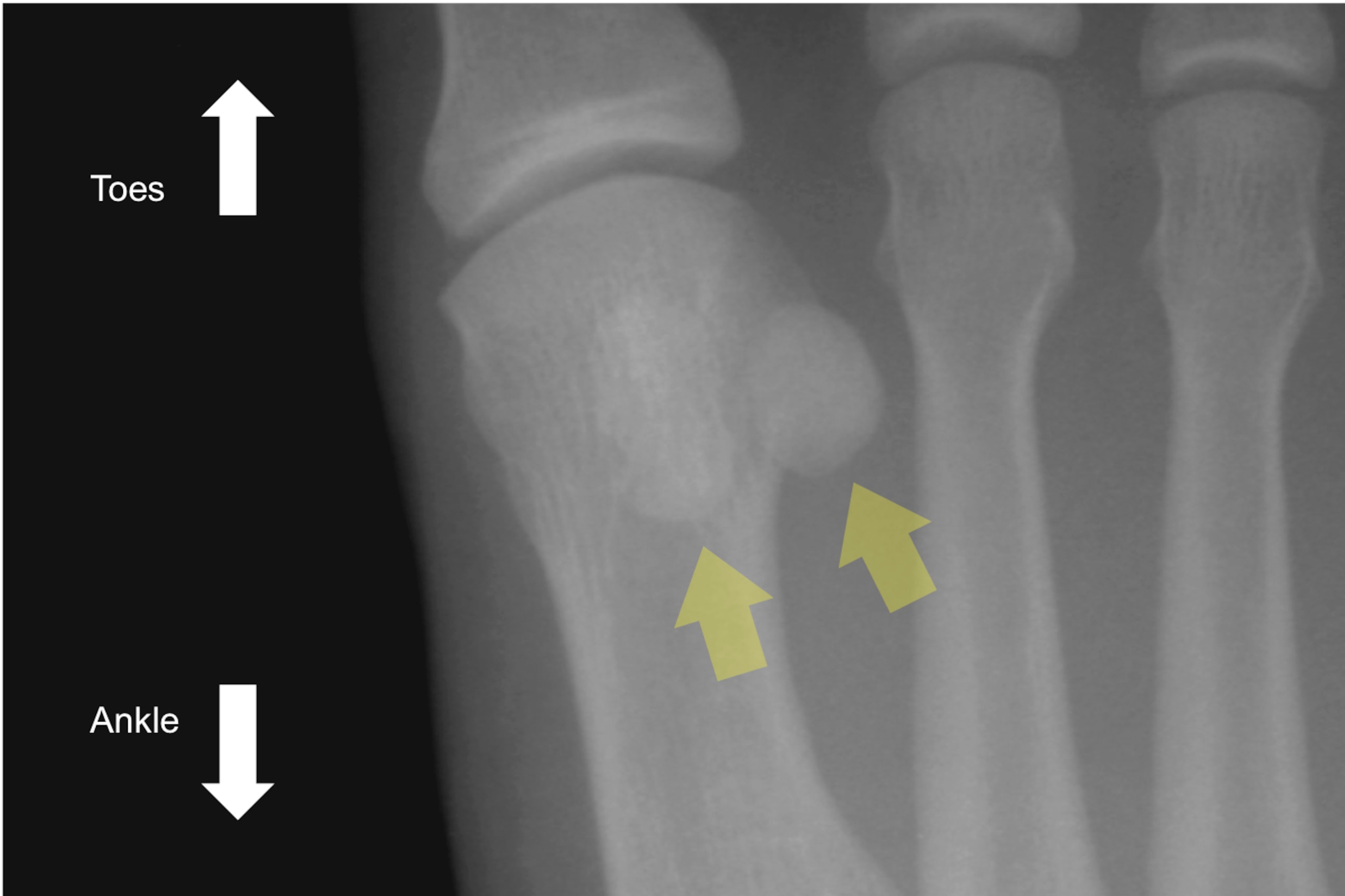 This X-ray shows the location of the two sesamoid bones—highlighted by yellow arrows—under the base of the big toe.