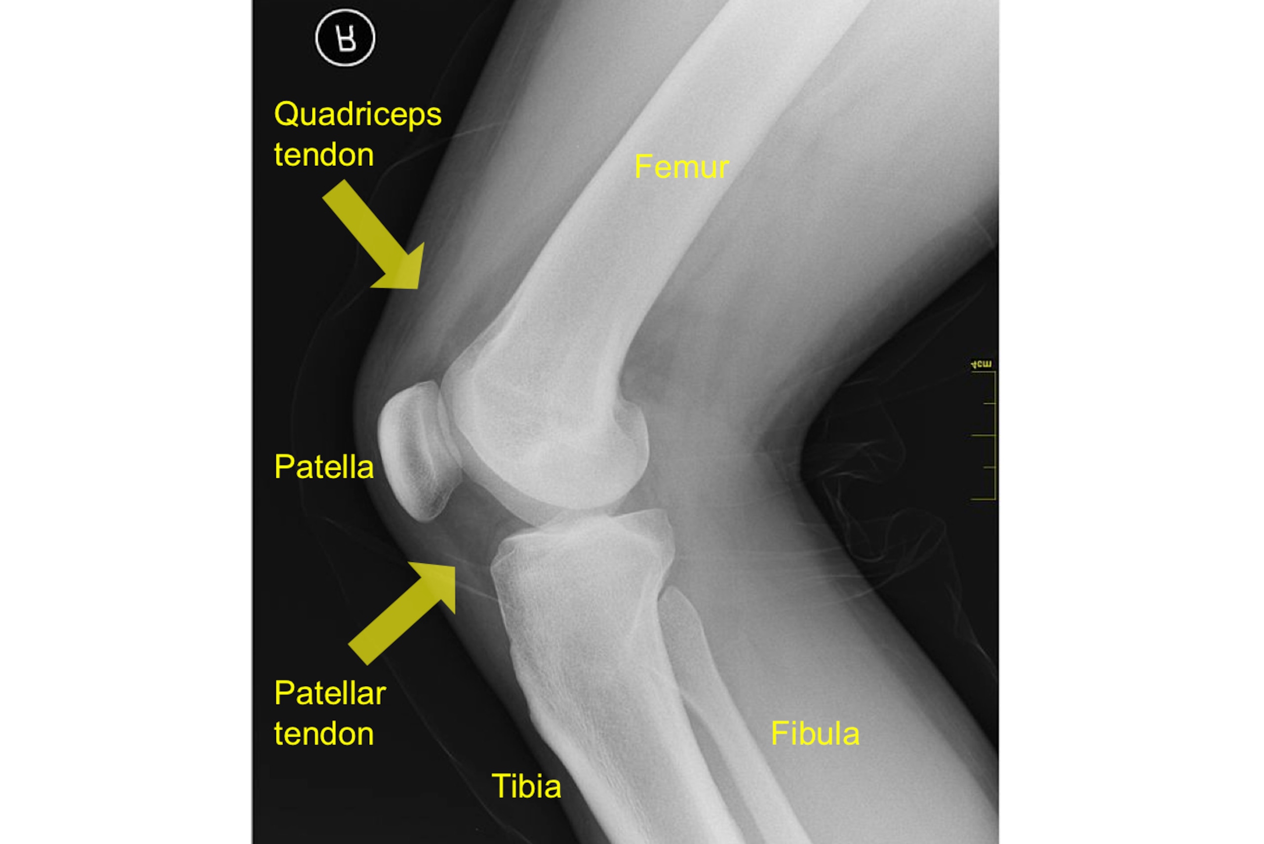 This X-ray shows the knee as viewed from the side. The two yellow arrows show the approximate location of the quadriceps and patellar tendons.