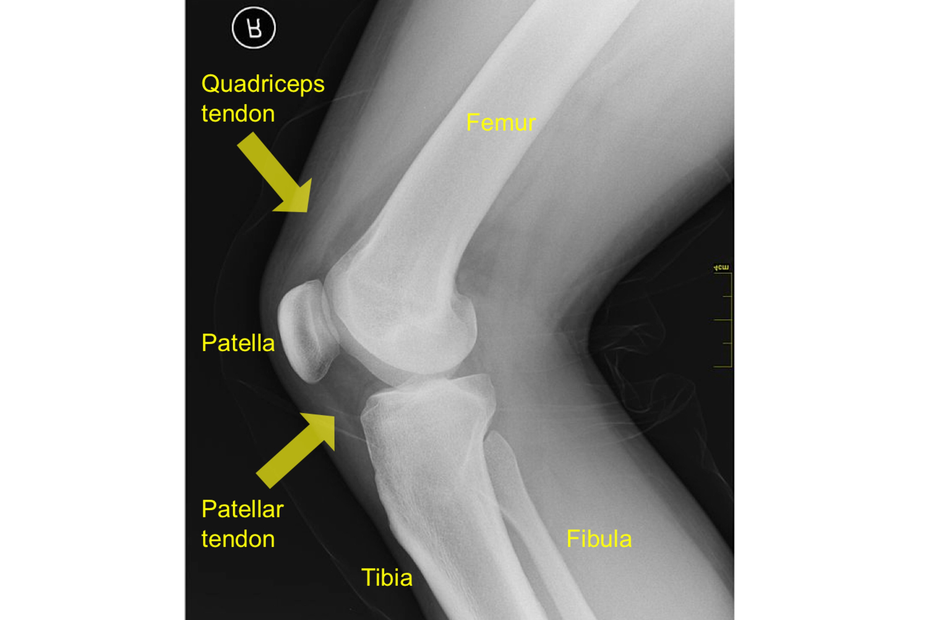 This X-ray shows the knee as viewed from the side. The two yellow arrows show the approximate location of the quadriceps and patellar tendons.