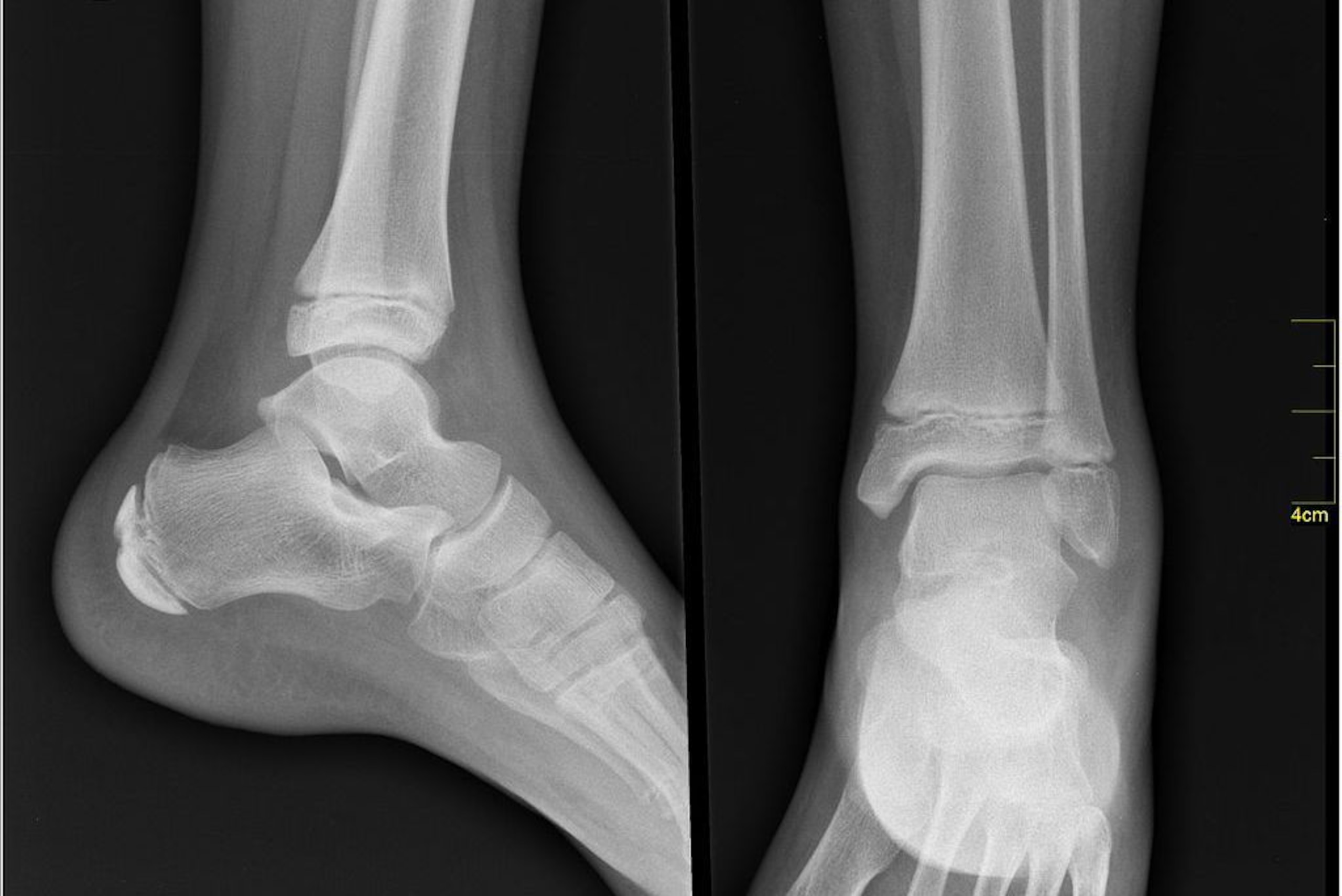 A high-ankle sprain injures the ligaments that connect the long bones of the lower leg—the tibia and fibula, seen above coming from the top of the X-ray—to each other.