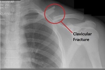 This X-ray shows a displaced clavicle fracture that usually needs surgery.