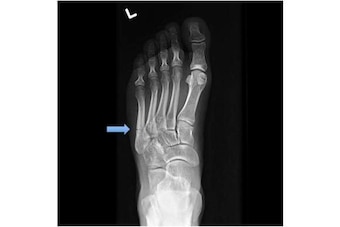 This X-ray shows a Jones fracture, highlighted by the blue arrow.