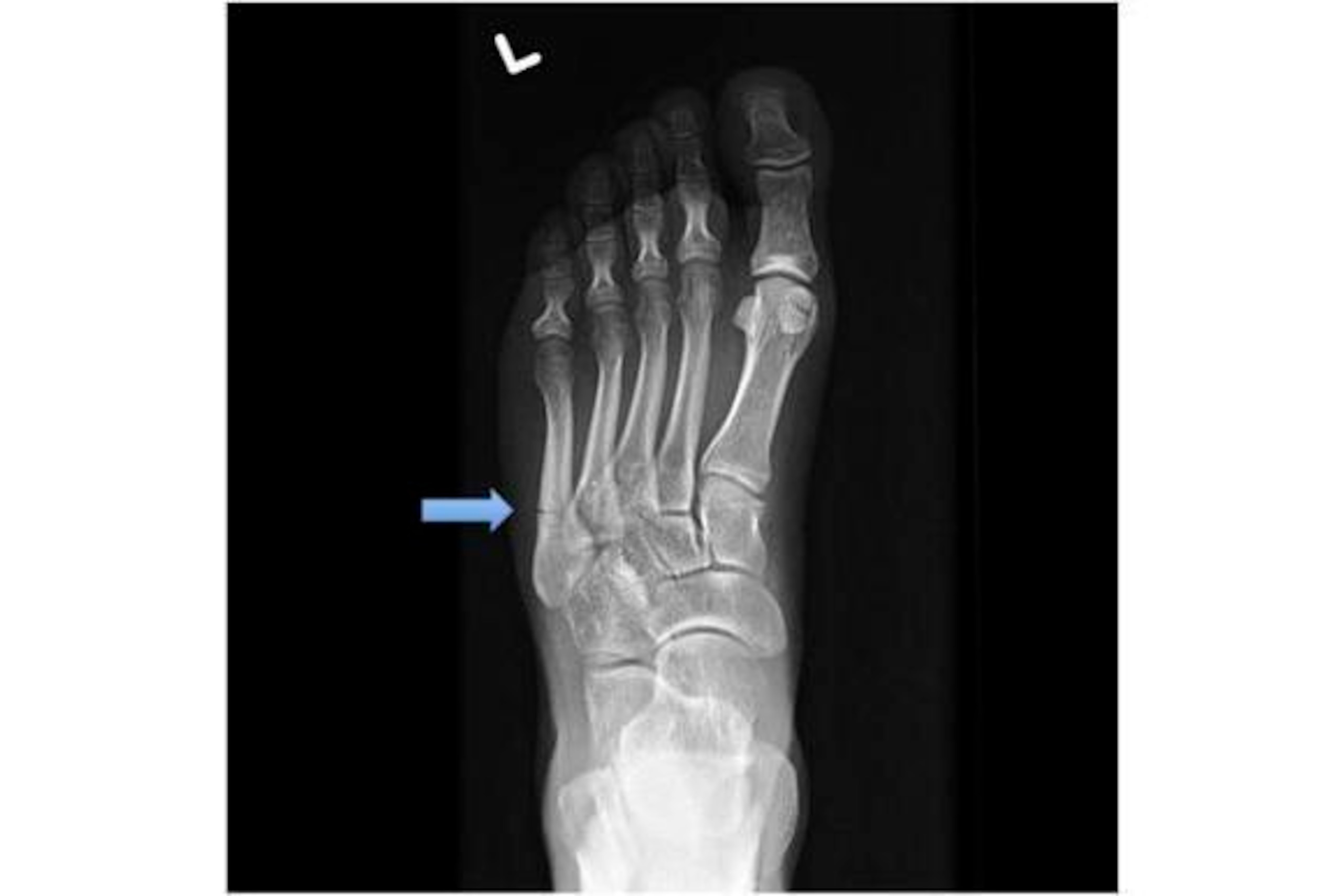 This X-ray shows a Jones fracture, highlighted by the blue arrow.