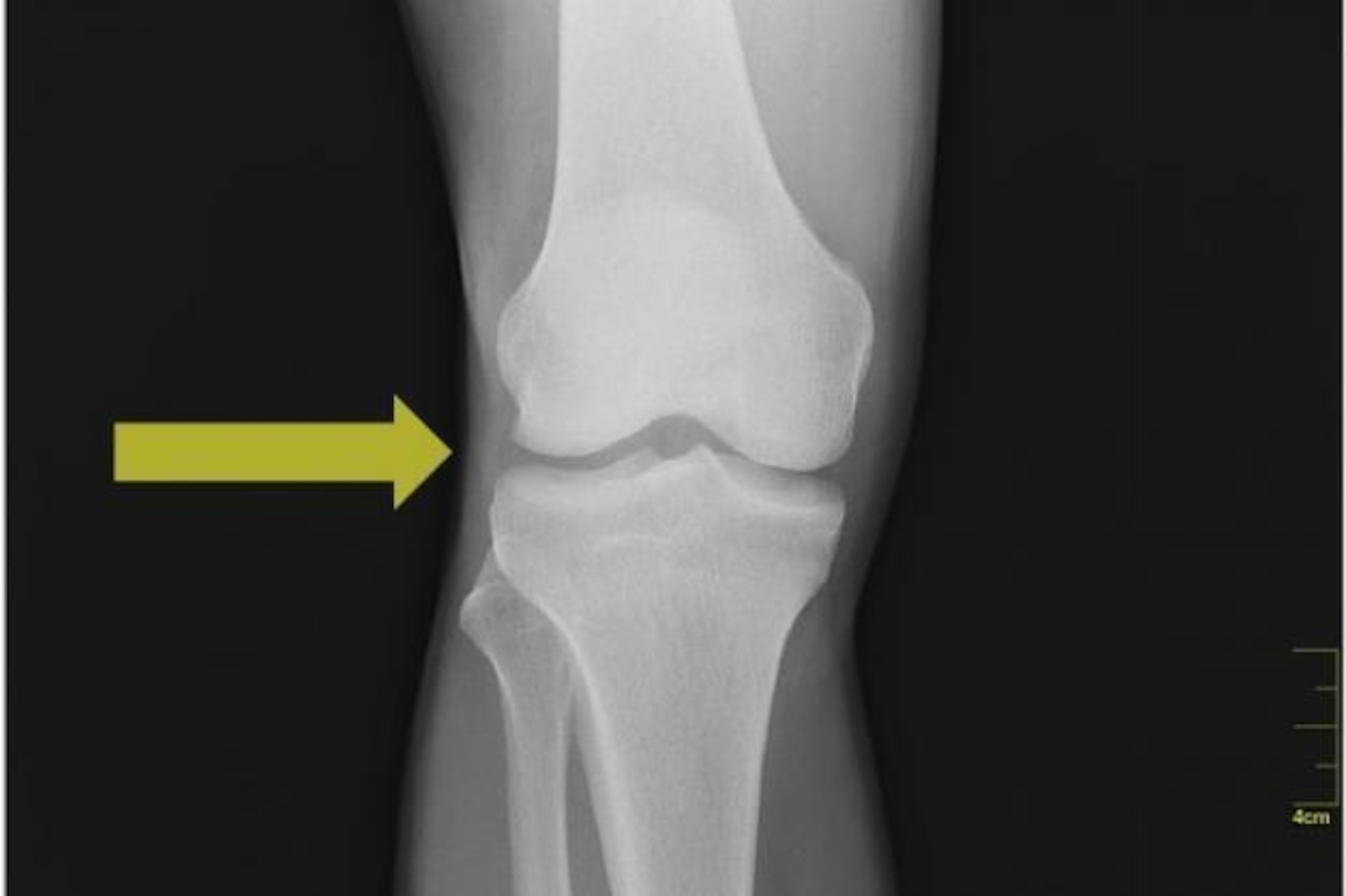 The two menisci lie between the femur—the thigh bone—and the tibia, or shin bone. The yellow arrow highlights the location of the lateral meniscus, as cartilage does not show up on X-ray.