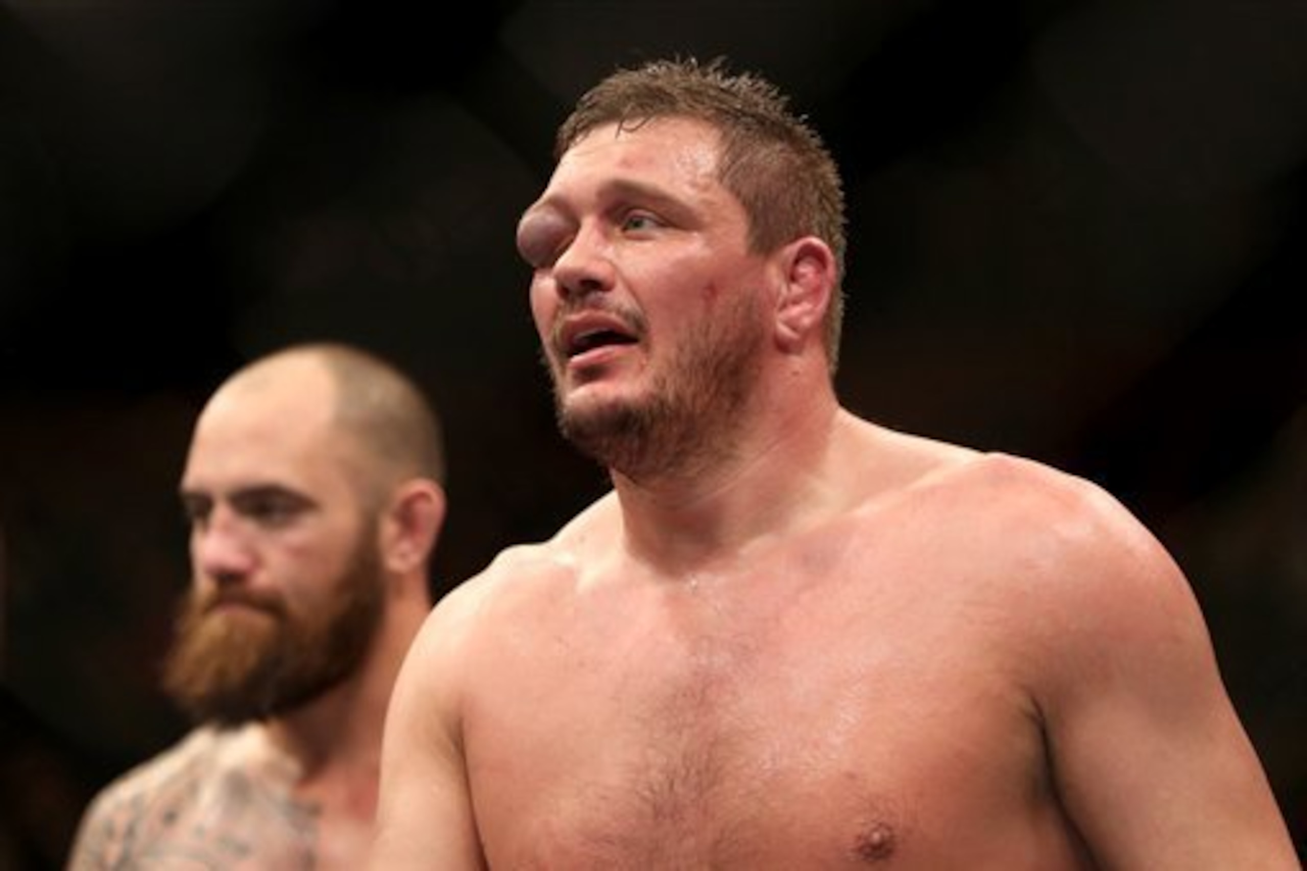 Mitrione injured his right shoulder during the fight, and his right eye...yeesh...