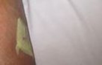 Zingano's knee post-surgery.