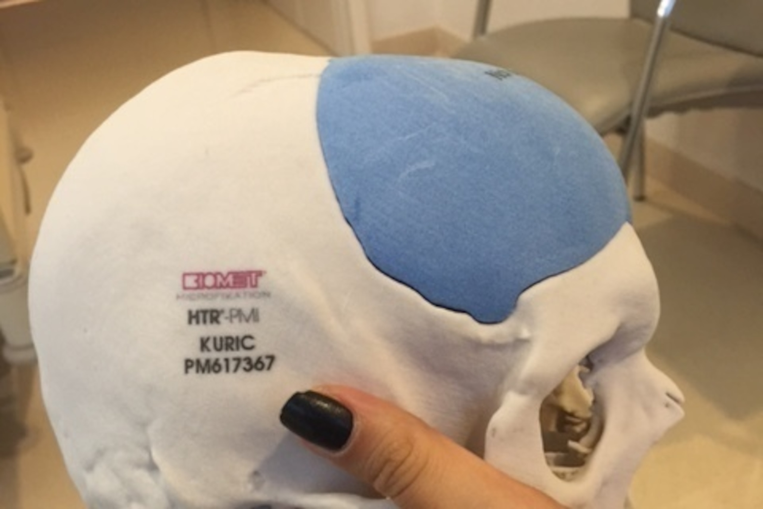 Kuric now wears this synthetic material at the front of his skull. Kuric now wears this synthetic material at the front of his skull.