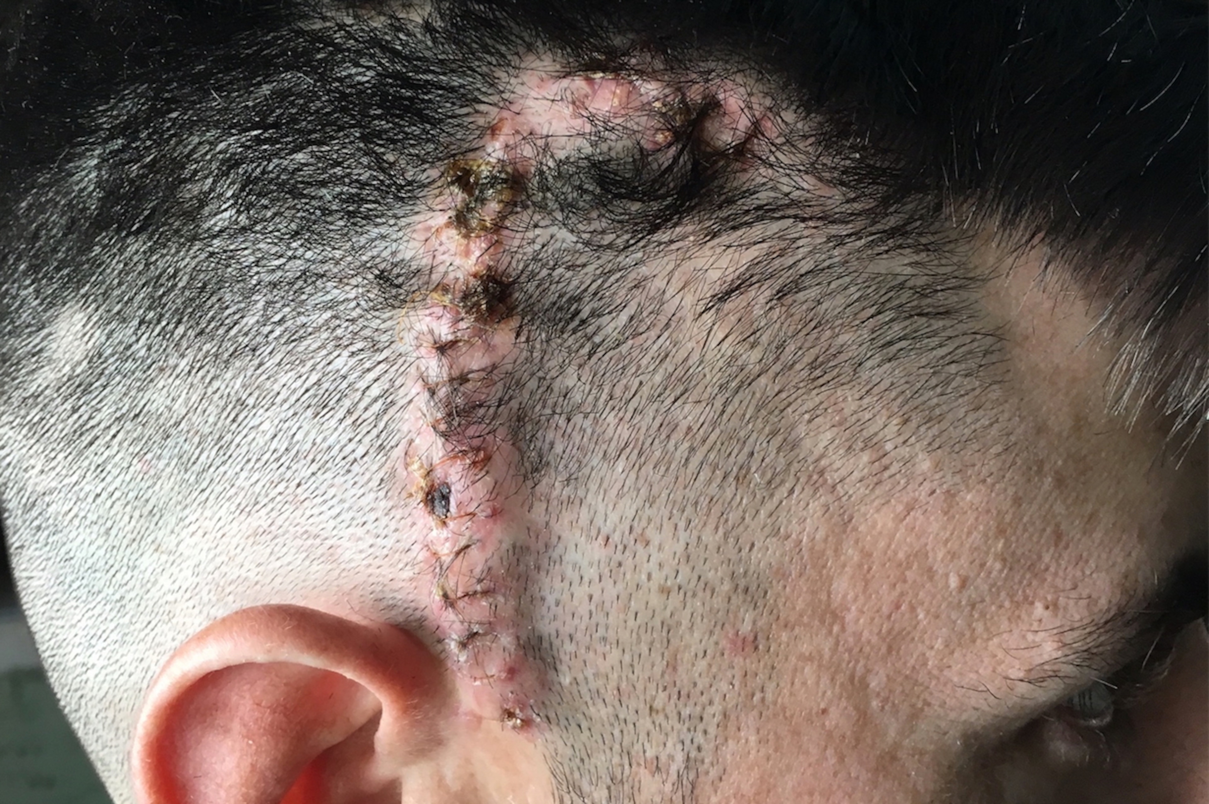 The scar left by Shoemaker's surgery.