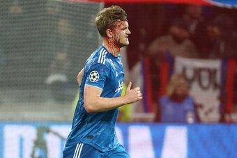 LYON, FRANCE - FEBRUARY 26: Matthijs de Ligt of Juventus is bleeding during the UEFA Champions League round of 16 first leg match between Olympique Lyonnais (OL) and Juventus at Groupama Stadium on February 26, 2020 in Decines near Lyon, France. (Photo by