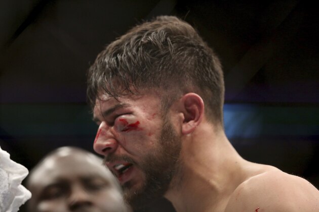 Yair Rodriguez and his damaged eye are seen after losing to Frankie Edgar in a mixed martial arts bout at UFC 211 on Saturday, May 13, 2017, in Dallas. Edgar won by doctor stoppage after round 2. (AP Photo/Gregory Payan)