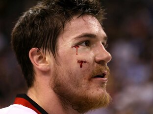 Andrew Shaw shows off his battle scars from last year's Stanley Cup Final.