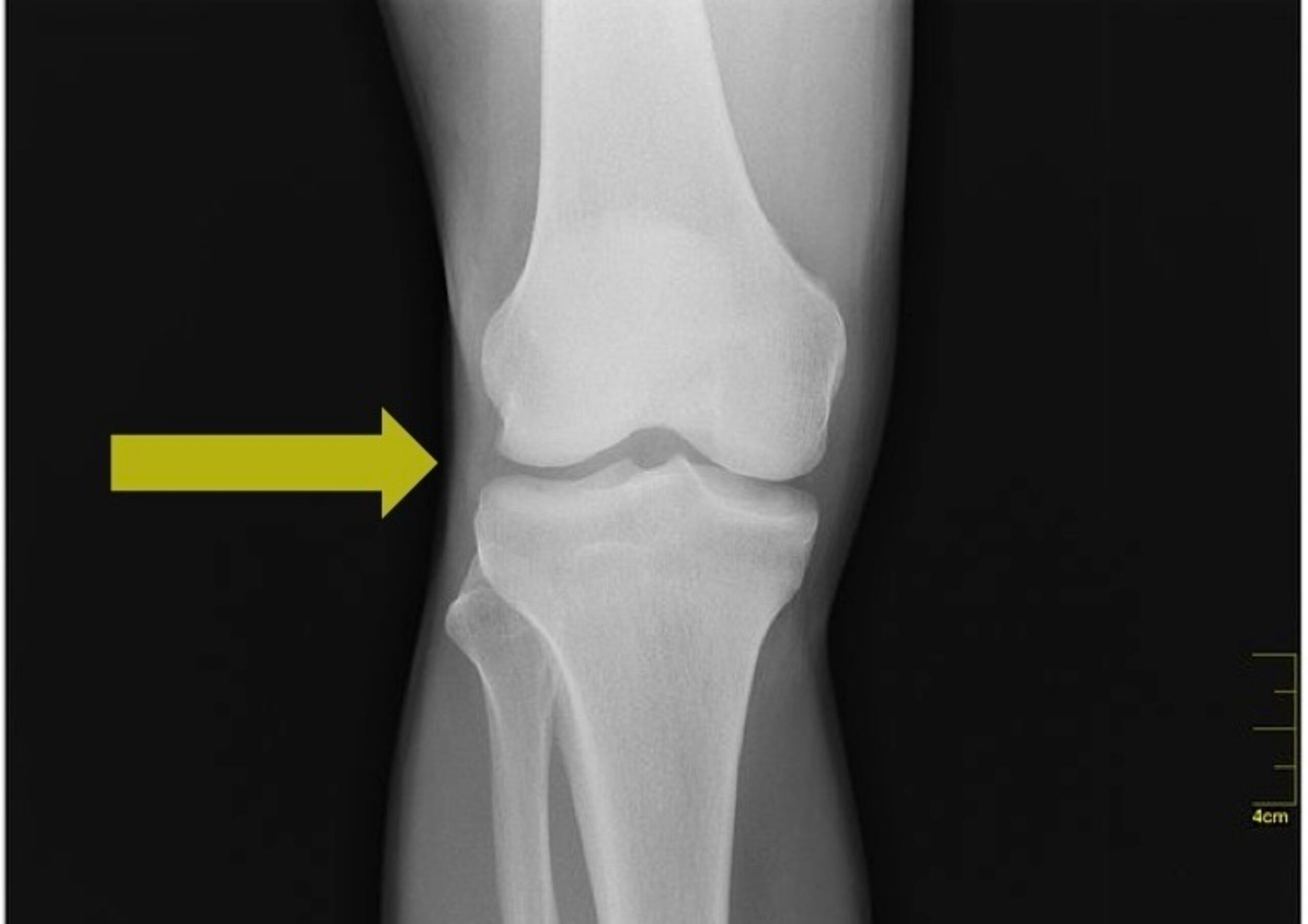 Though X-rays do not show soft tissue, the two menisci sit between the tibia (shine bone) and femur (thigh bone). The yellow arrow highlights this location.