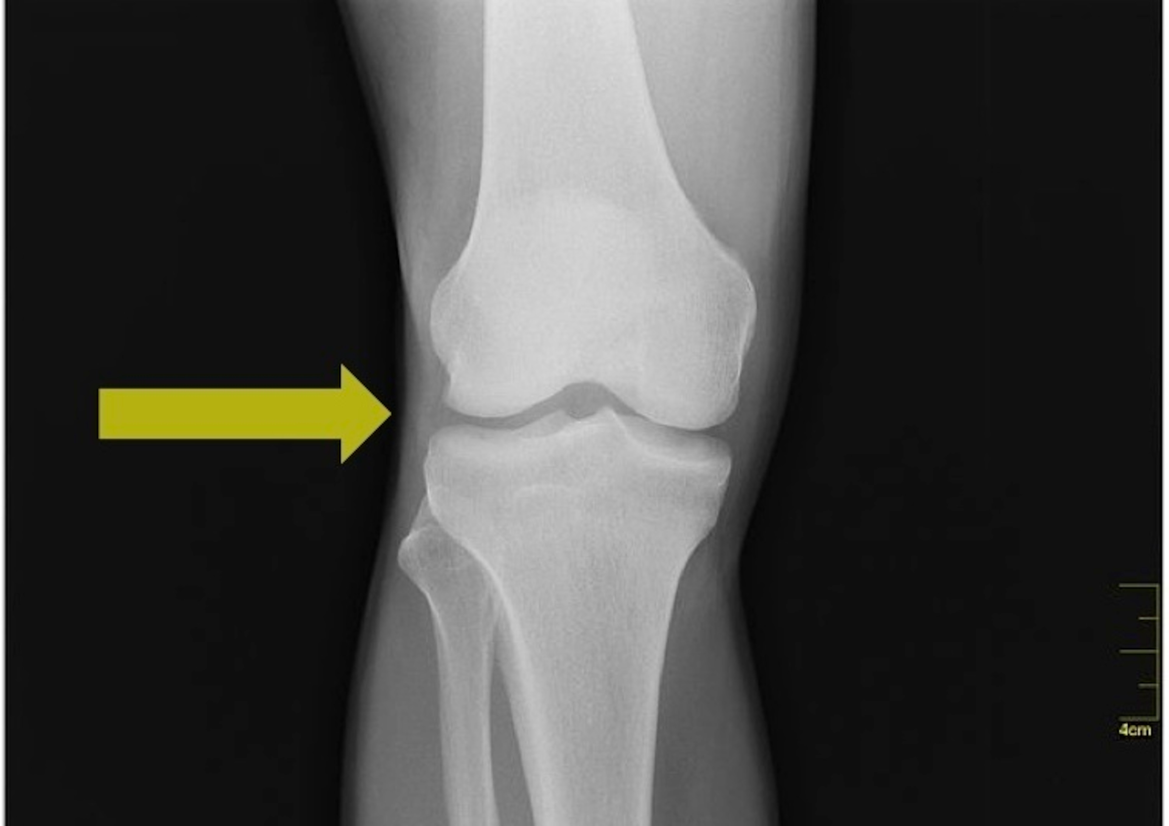Though X-rays do not show soft tissue, the two menisci sit between the tibia (shine bone) and femur (thigh bone). The yellow arrow highlights this location.