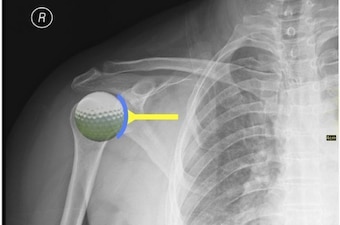 If the shoulder joint is a golf ball sitting on a tee, the labrum makes the tee's surface larger (represented by the blue arc in the above X-ray). If the shoulder joint is a golf ball sitting on a tee, the labrum makes the tee's surface larger (represented by the blue arc in the above X-ray).