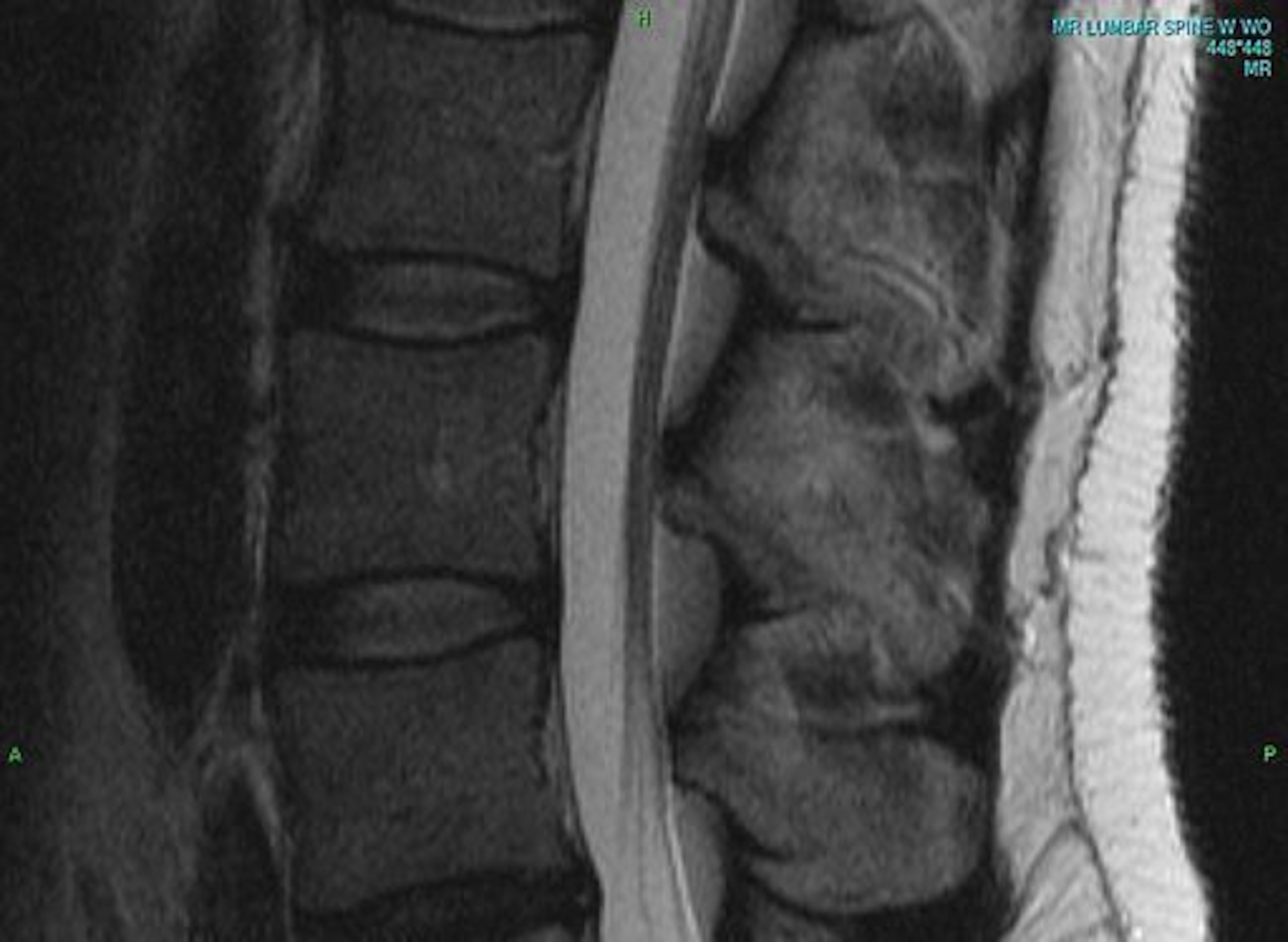 This lumbar spine MRI clearly shows three vertebrae and two intervertebral discs.